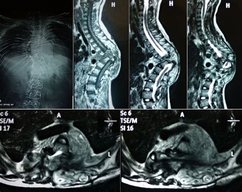 kyphosis icd 10|More.